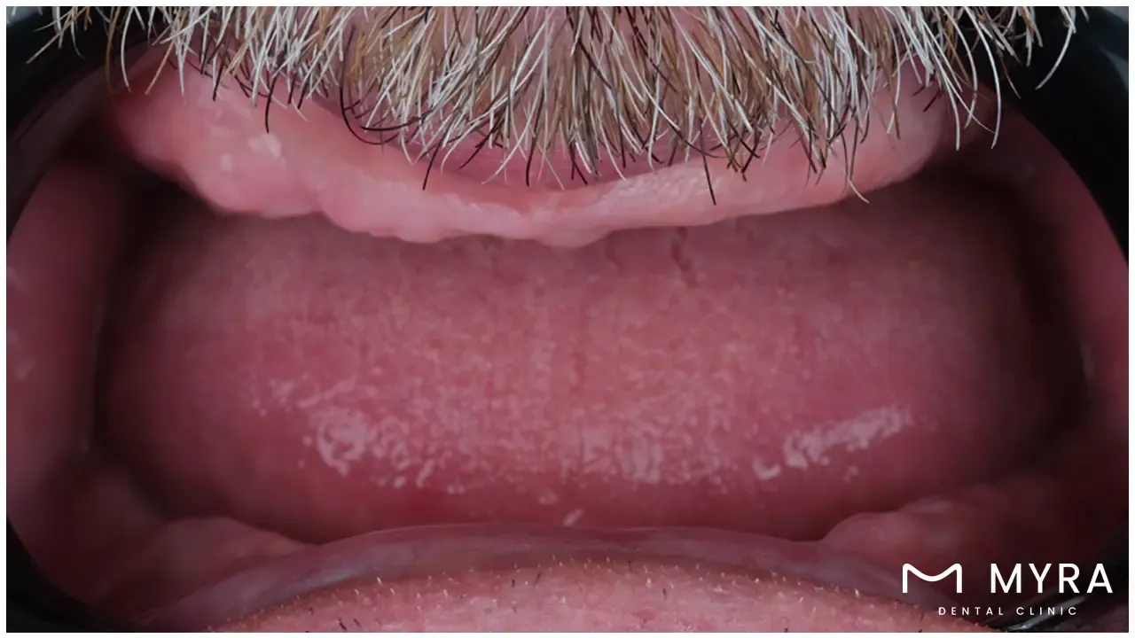 When is an All-on-4 Dental Implant required_.webp